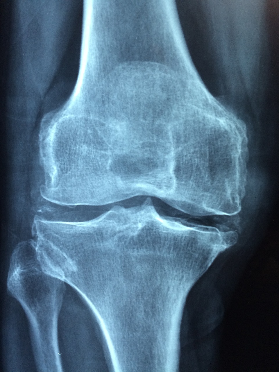 Osteoporosis: Understanding and Combating the Silent Disease